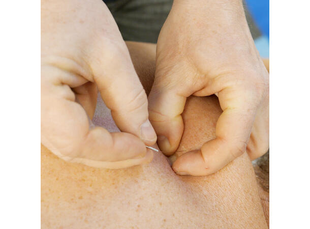 Dry Needling Advanced Oslo, 13.-14. juni 2025
