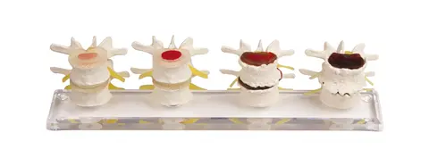 Degenerativ Ryggmodell 7577 Fire deler