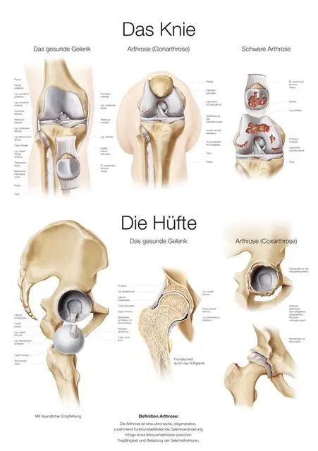 Plakat The Knee & Hip AL551 50 x 70 cm Plast 